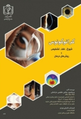 کراتوکونوس شیوع علت تشخیص و روش‌های درمان